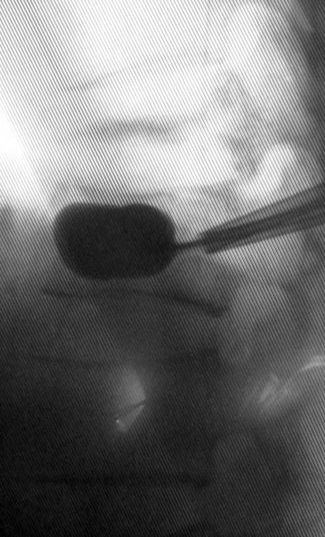 BKP（経皮的椎体形成術）
