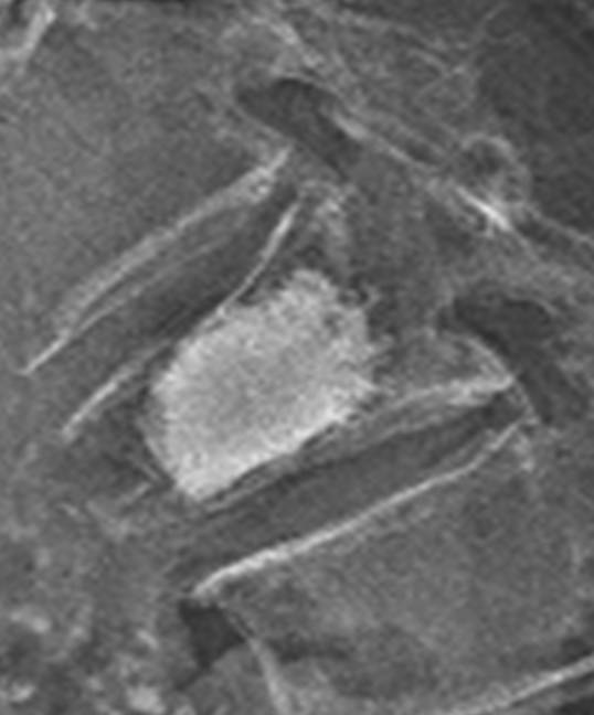 BKP（経皮的椎体形成術）2