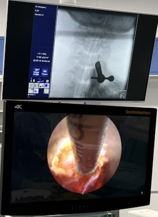 PECF（内視鏡下頚椎椎間孔拡大術）