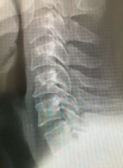 頚椎前方固定術