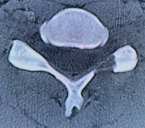 PECF（内視鏡下頚椎椎間孔拡大術）