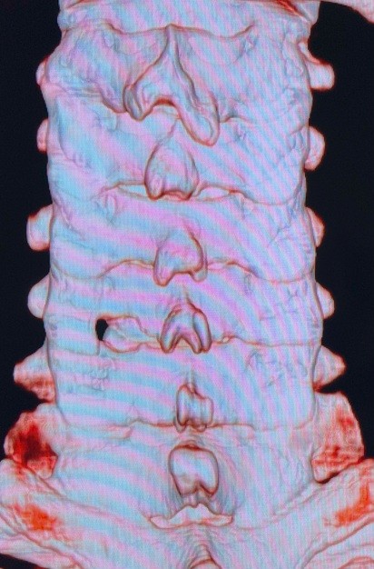 PECF（内視鏡下頚椎椎間孔拡大術）