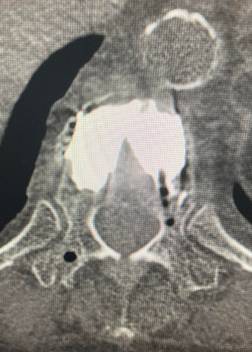 BKP（経皮的椎体形成術）2