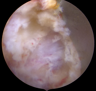 PECF（内視鏡下頚椎椎間孔拡大術）