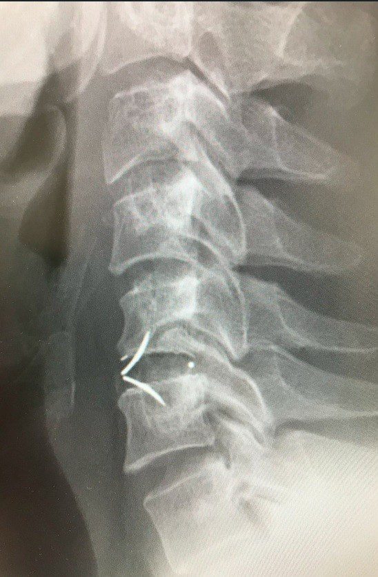 頚椎前方固定術